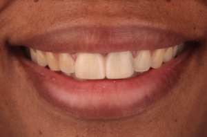 A dental patient after receiving diagnostic dental mock up teeth. 