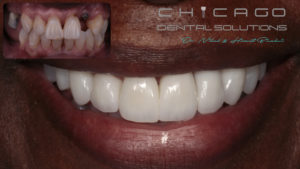 A recent before and after image of a patient who received Chicago dental implants. 