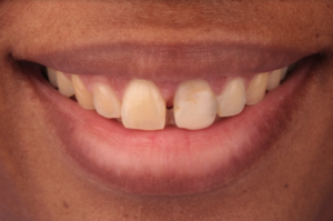 A dental patient prior to receiving diagnostic dental mock up teeth. 